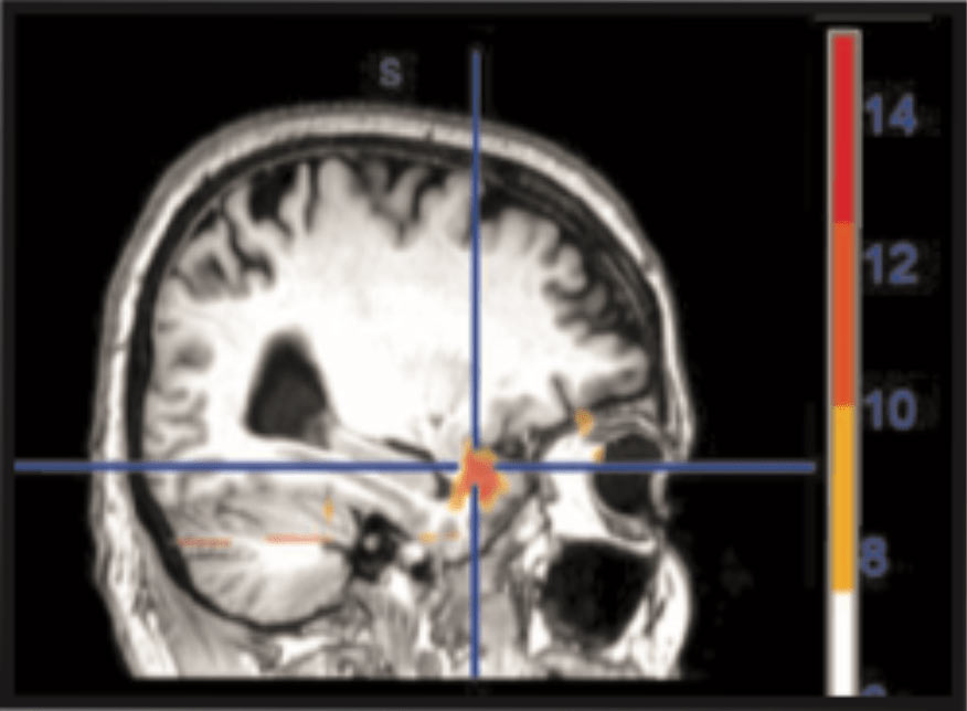 Brain fMRI of unresolved trauma patient before Neuro-Emotional Technique treatment